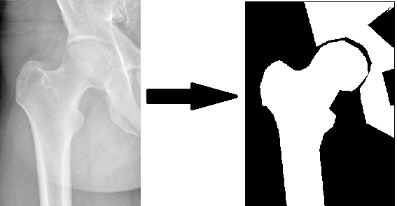 Femur Boyun