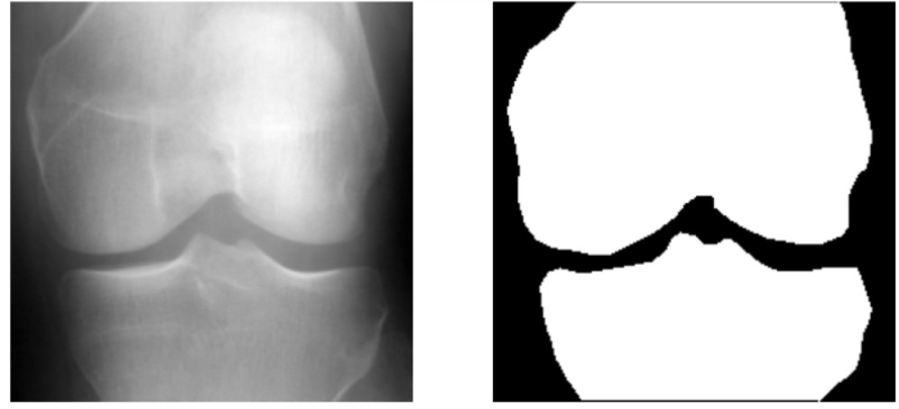 Diz osteoartrit