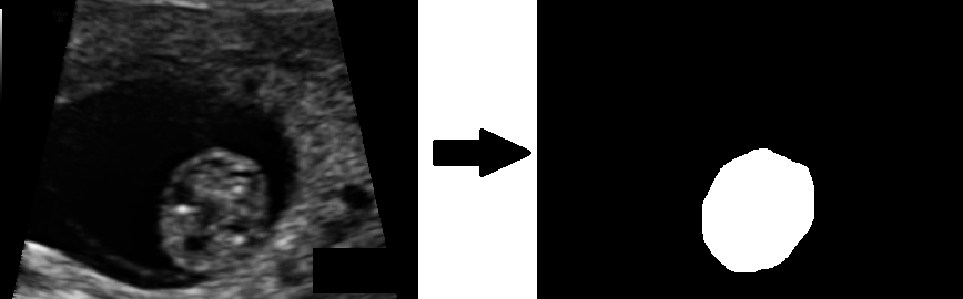 Fetal Baş Çevresi