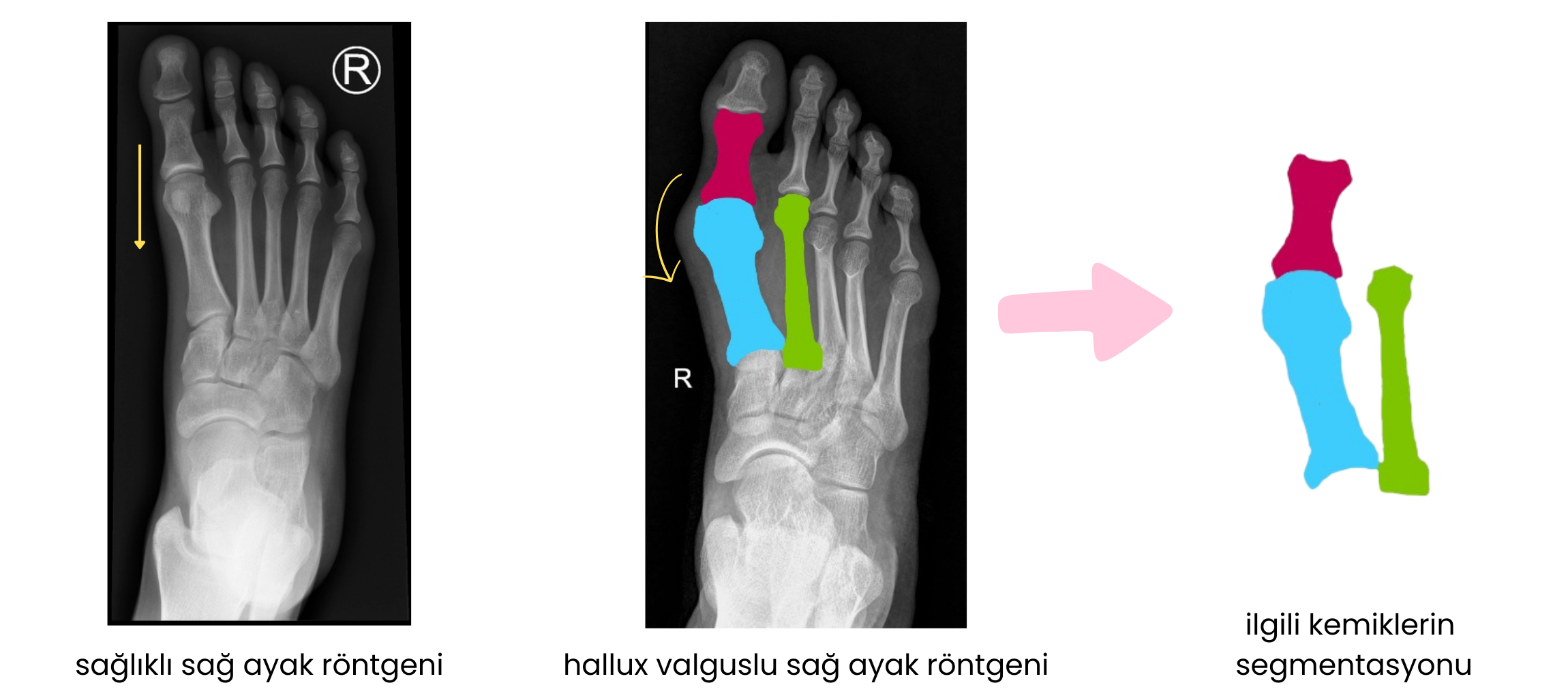 Hallux Valgus