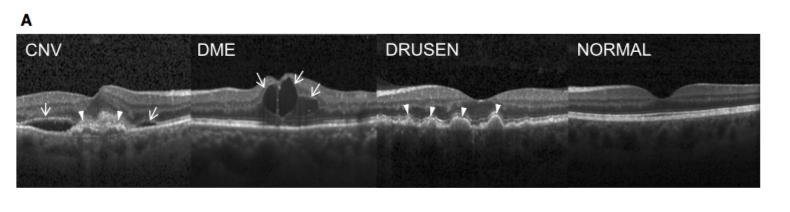 Retinal CNV