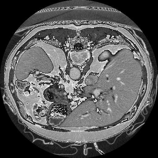 Sağ Adrenal Bez