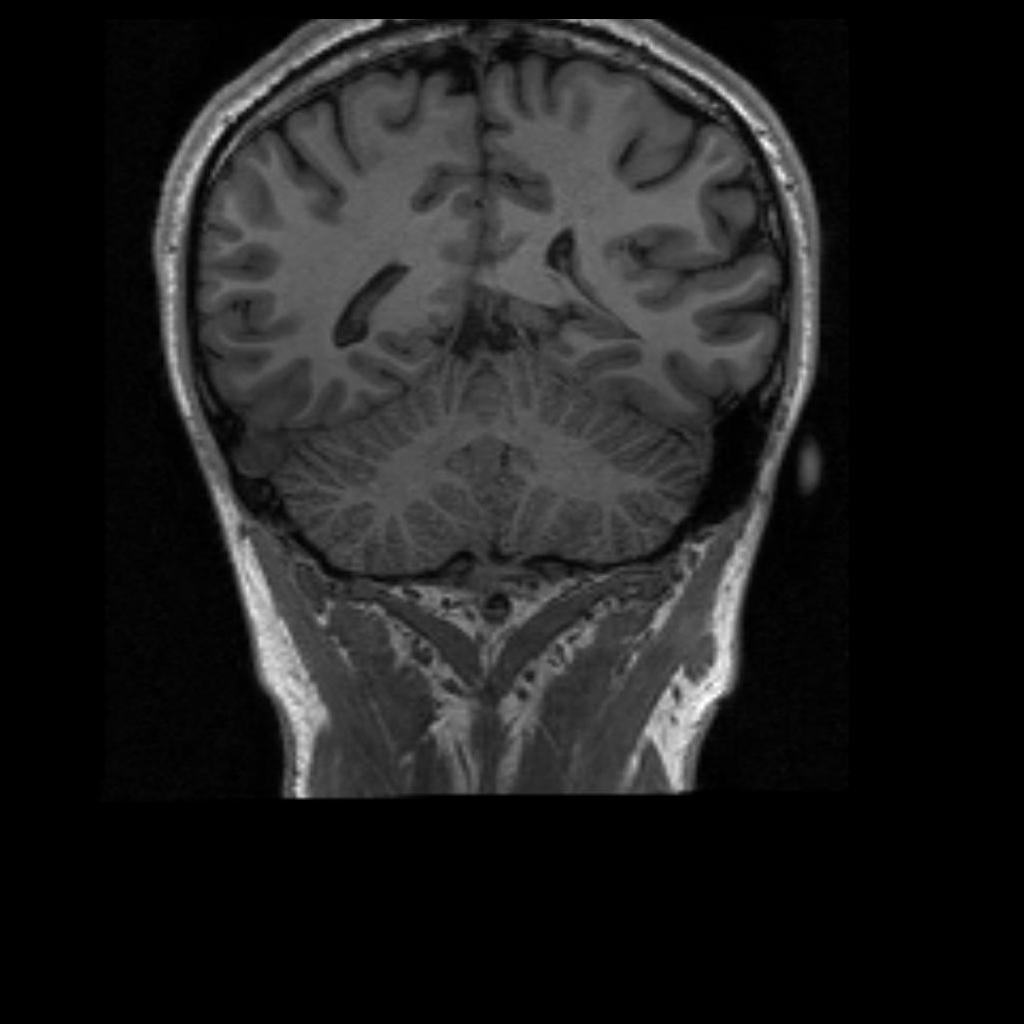 Cerebellium