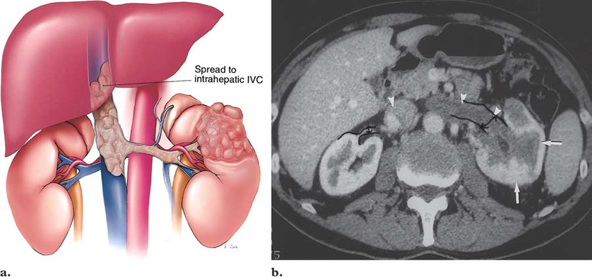 Renal Ven