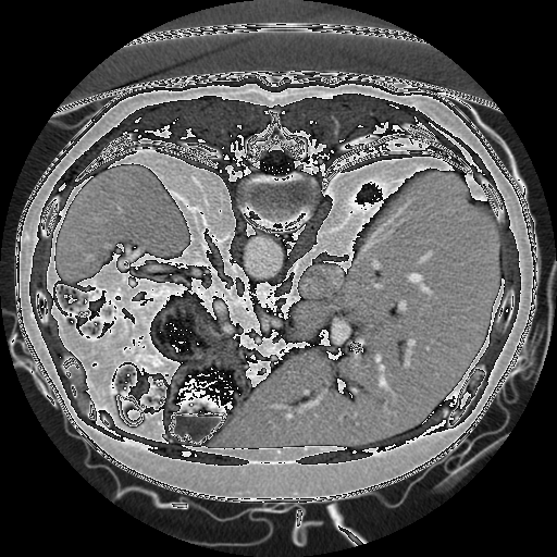 Aorta