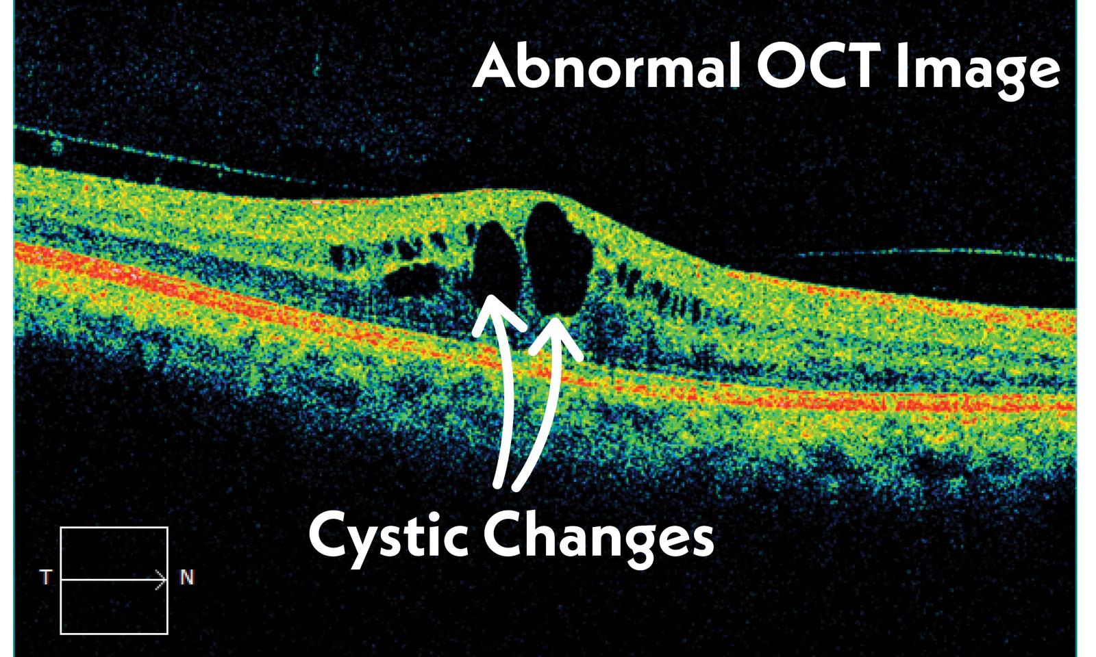 Retinal CNV