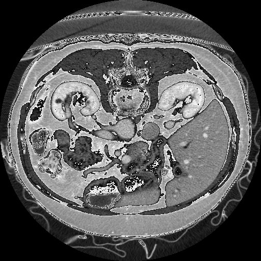 Inverior Vena Cava