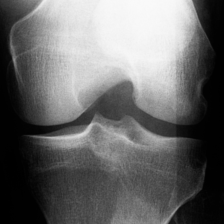 Diz osteoartrit