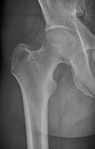 Femur Boyun