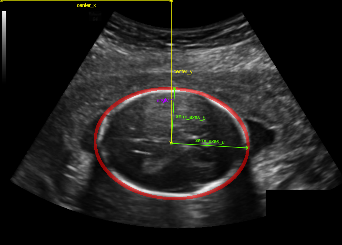 Fetal Baş Çevresi